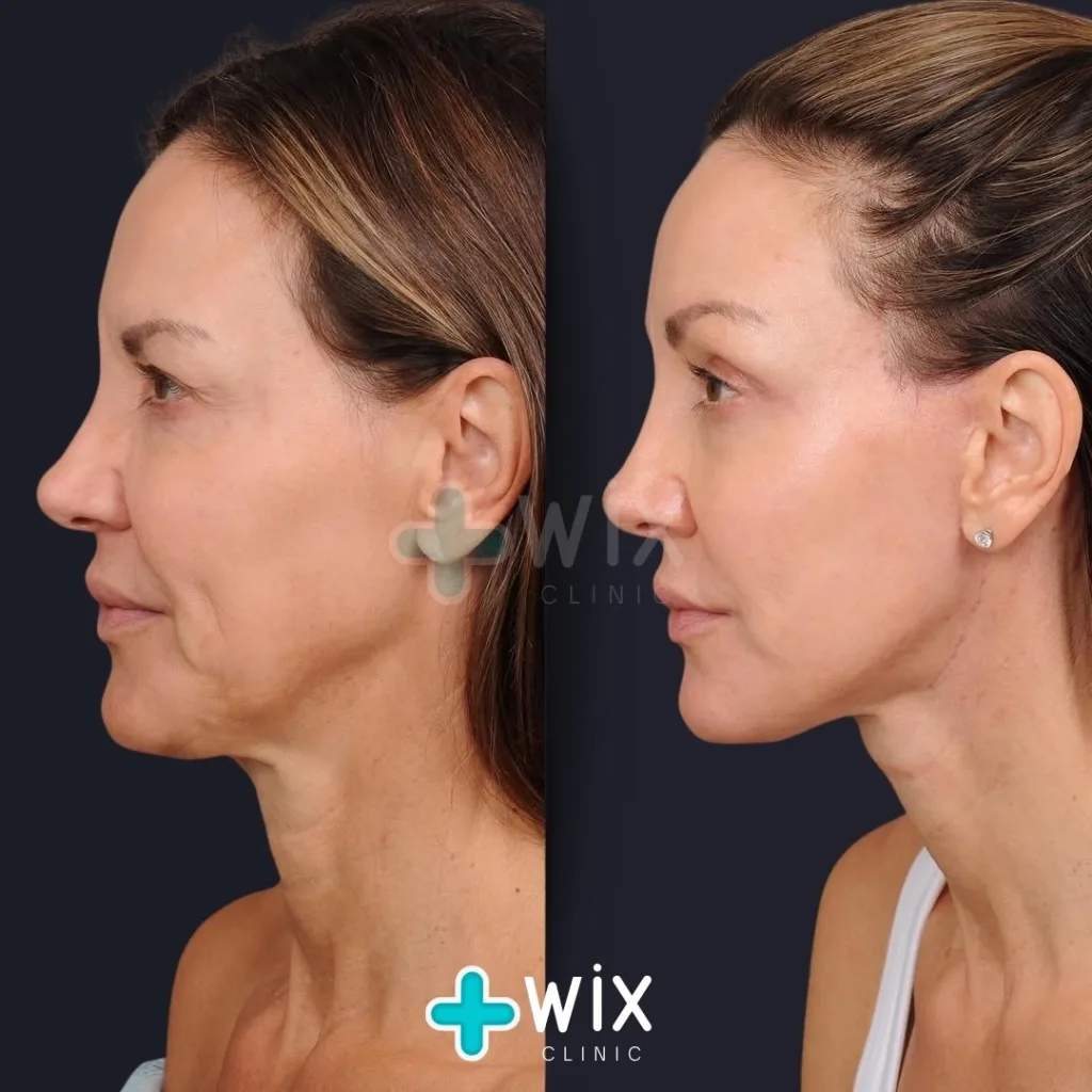 Neck Liposuction Before and After