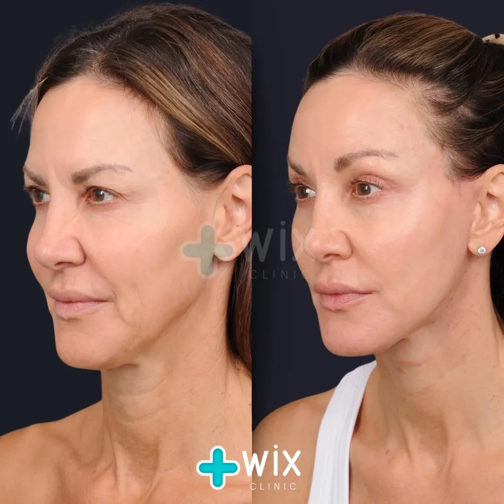 Neck Liposuction Before and After