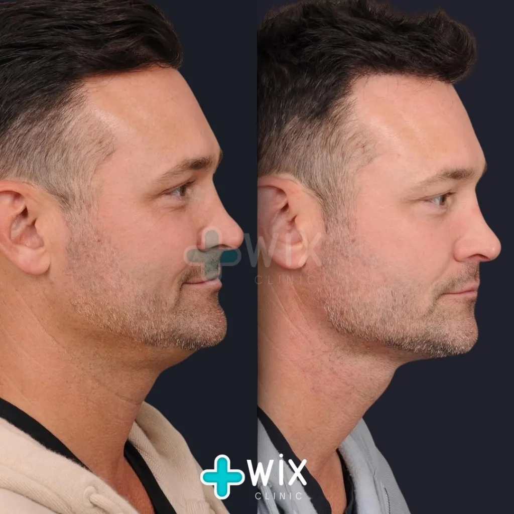 Neck Liposuction Before and After