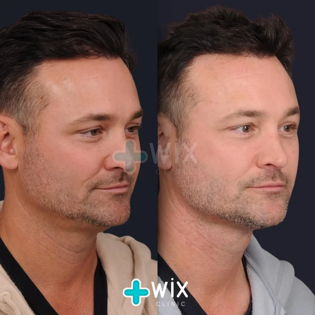 Neck Liposuction Before and After