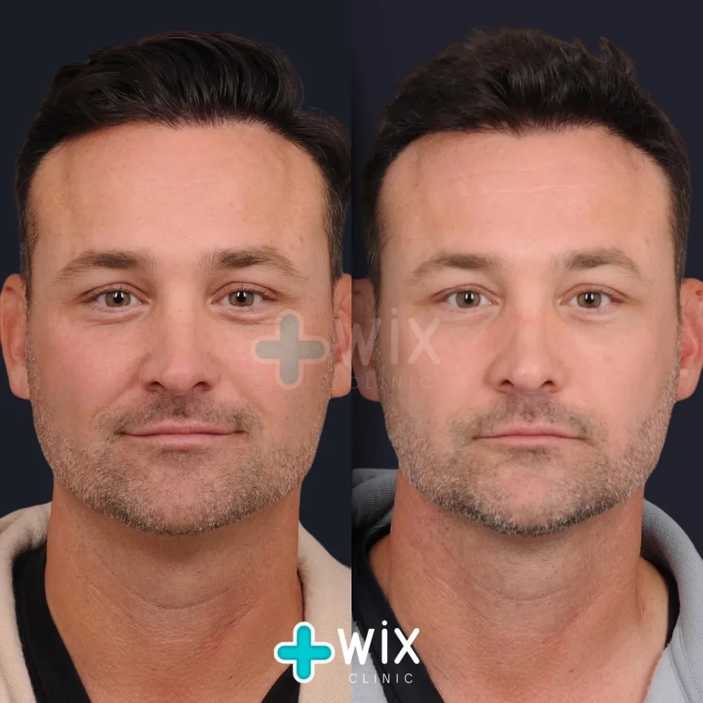 Neck Liposuction Before and After