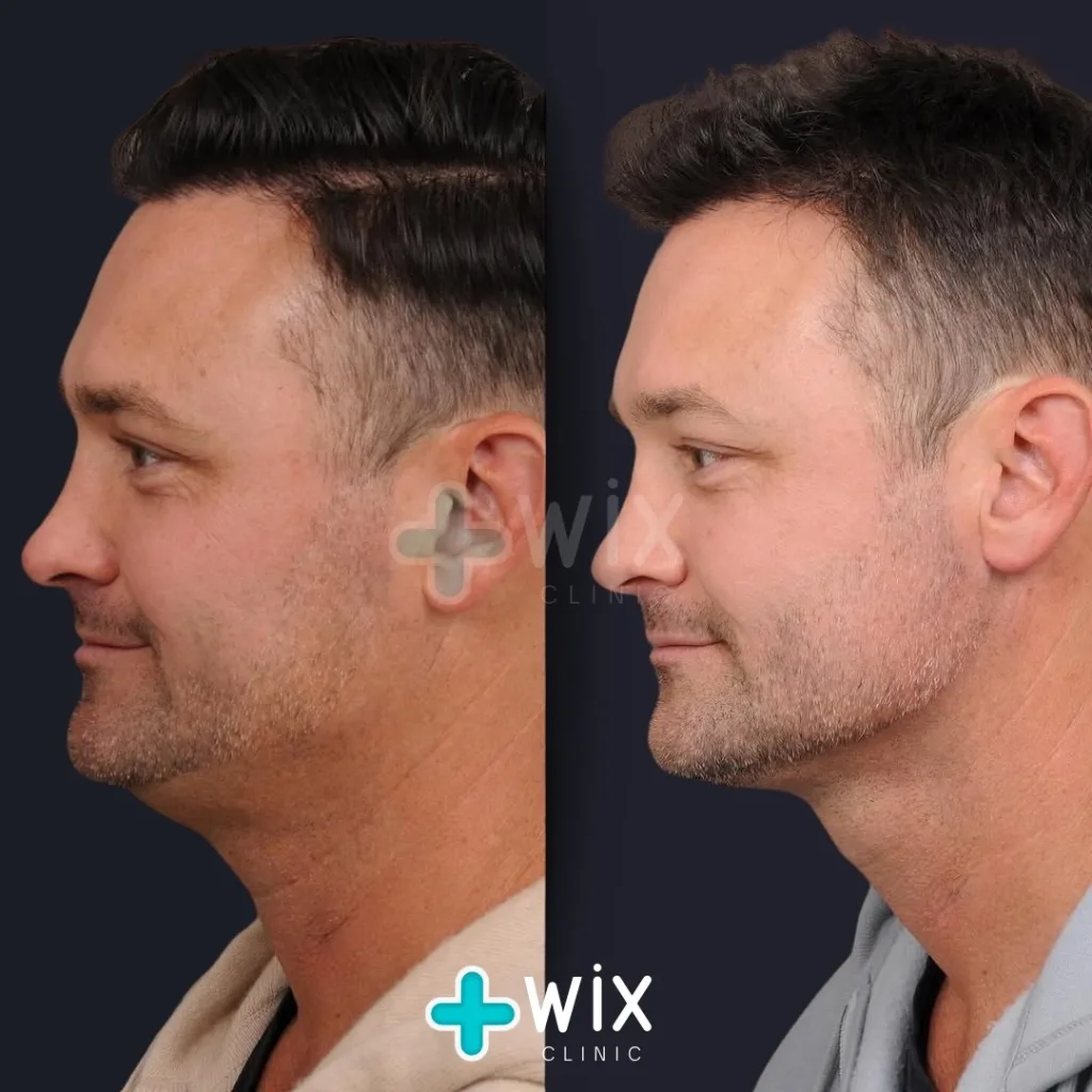 Neck Liposuction Before and After