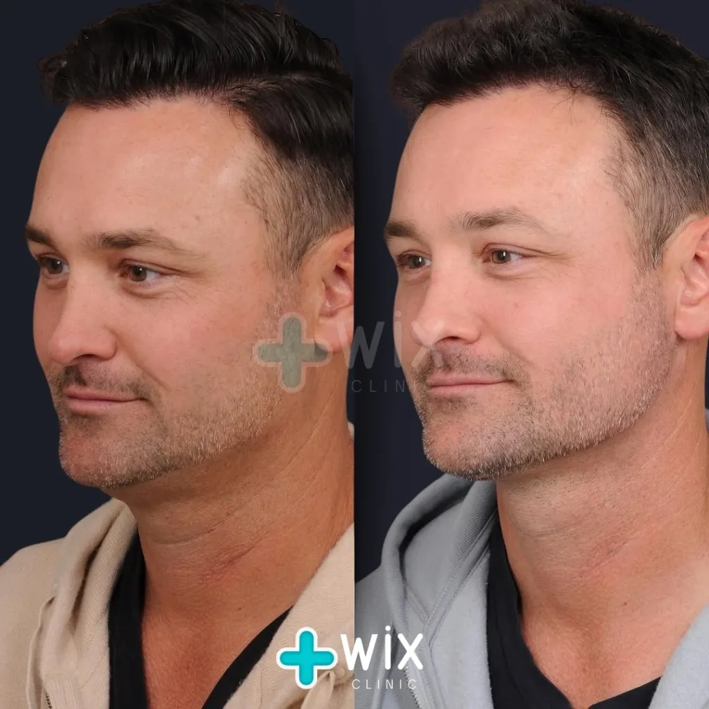 Neck Liposuction Before and After