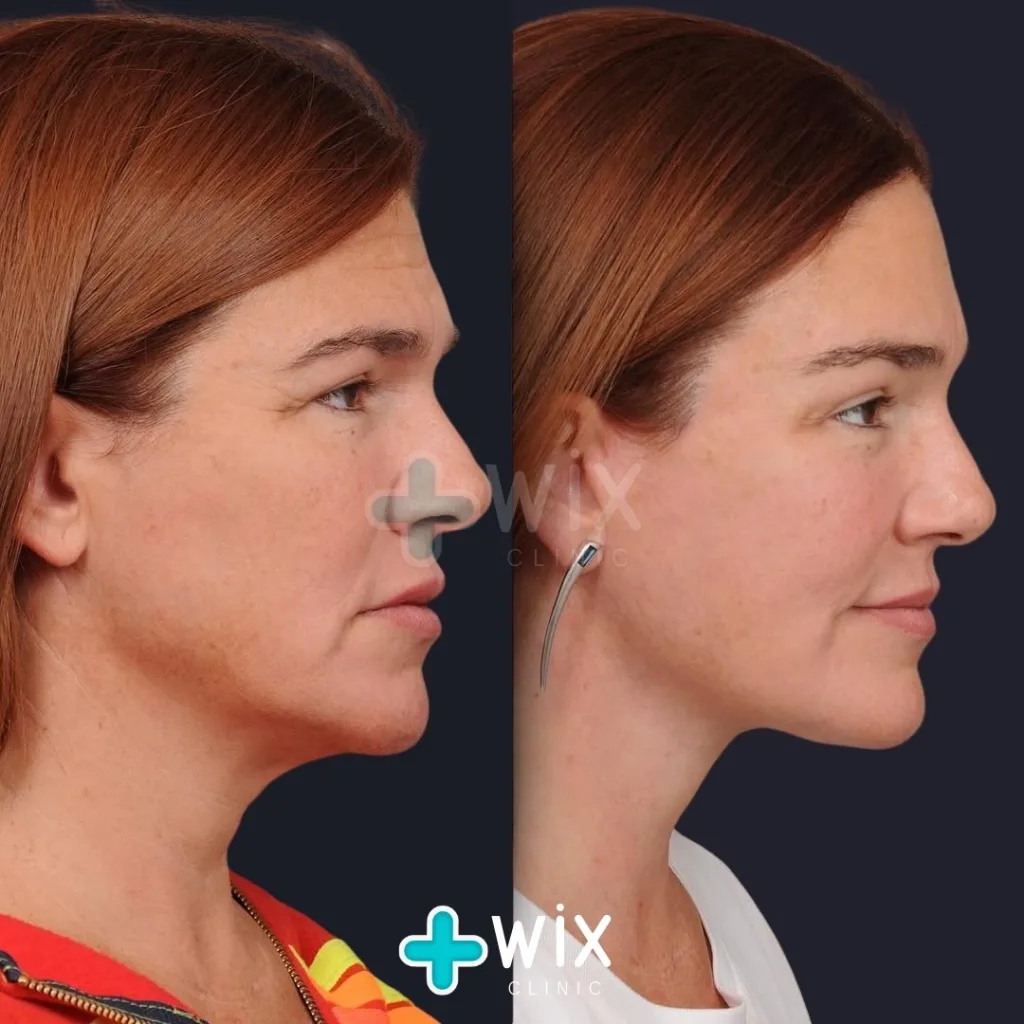 Neck Liposuction Before and After