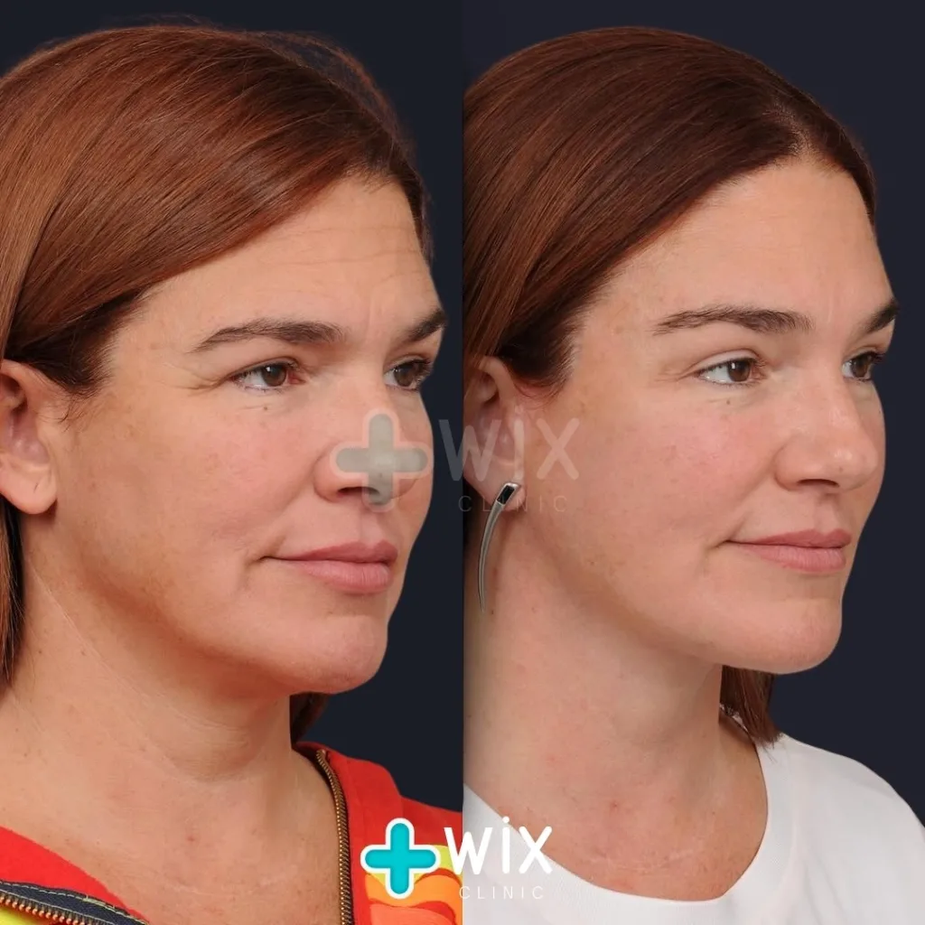 Neck Liposuction Before and After