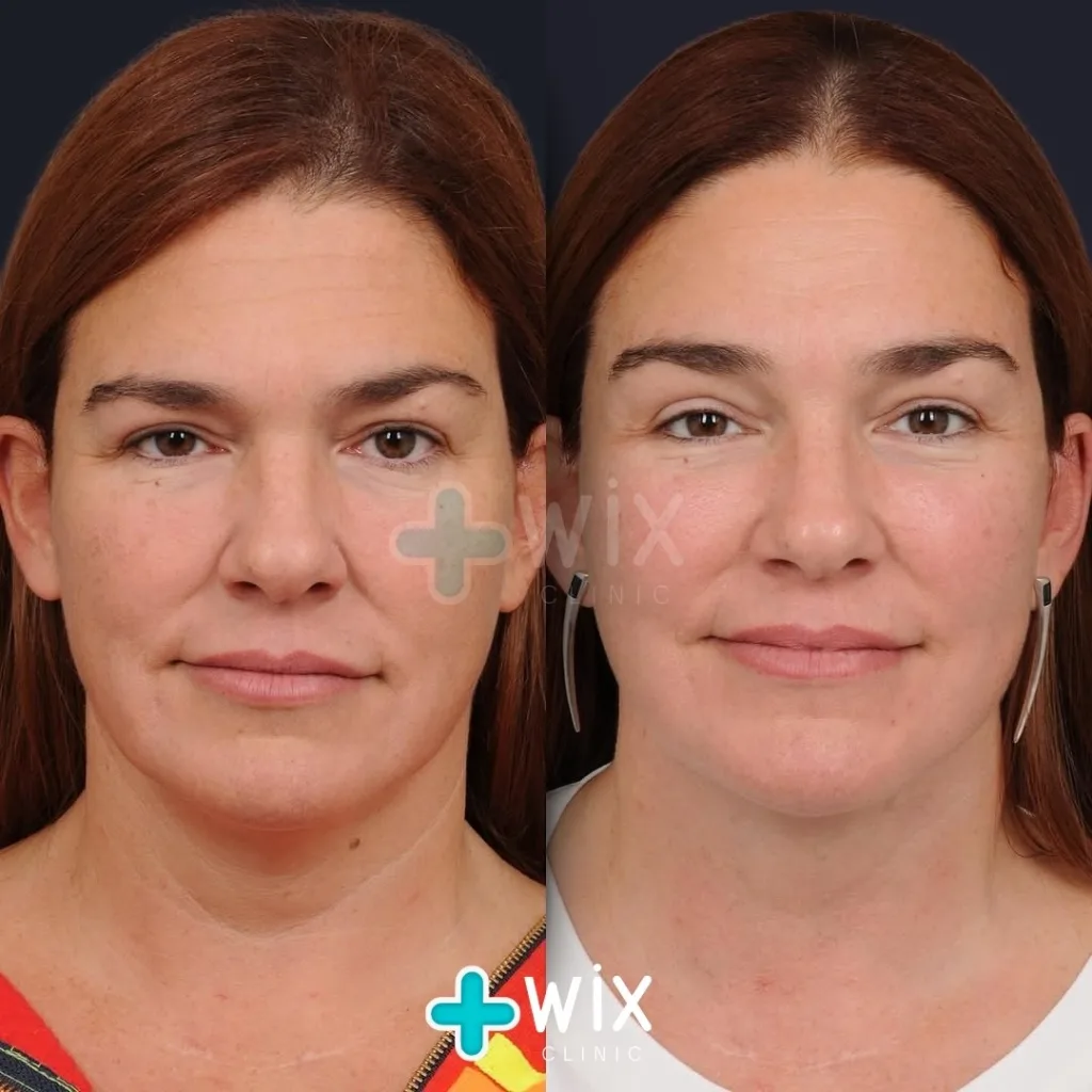 Neck Liposuction Before and After