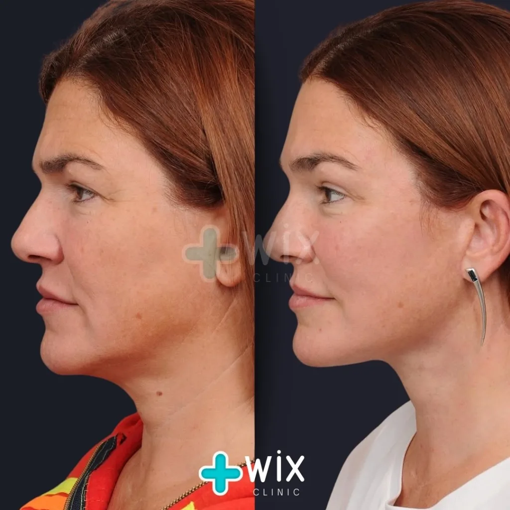 Neck Liposuction Before and After