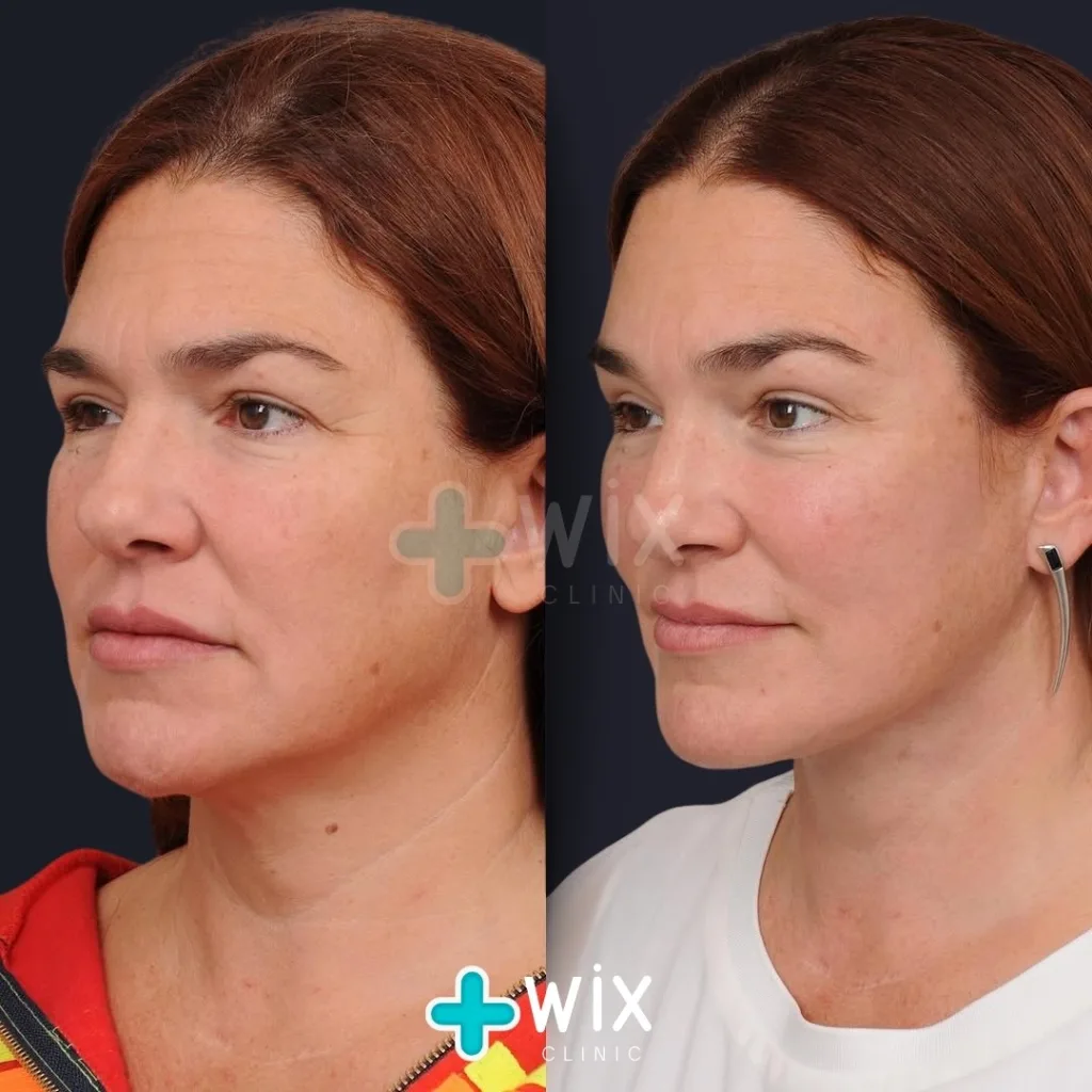 Neck Liposuction Before and After