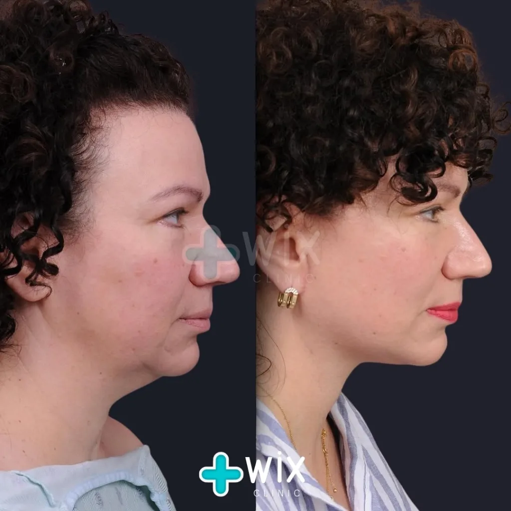 Neck Liposuction Before and After