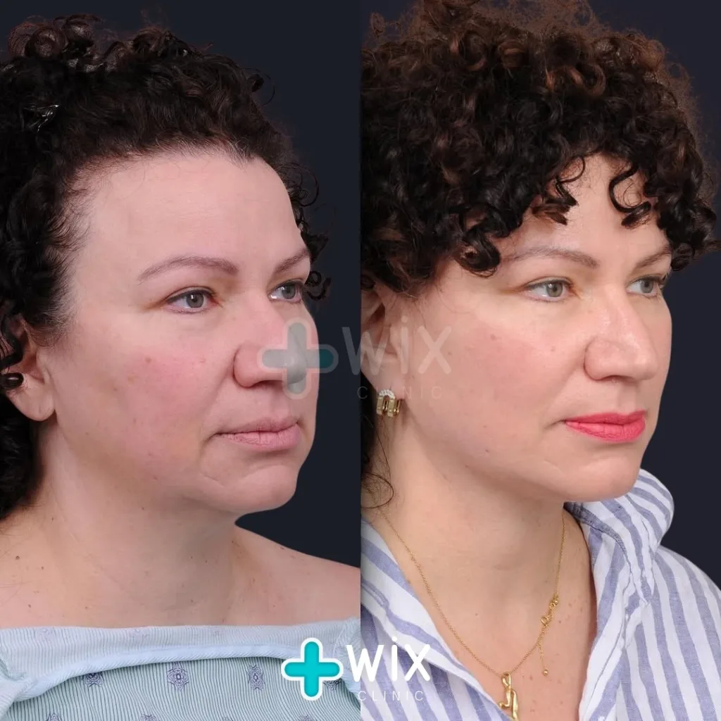 Neck Liposuction Before and After