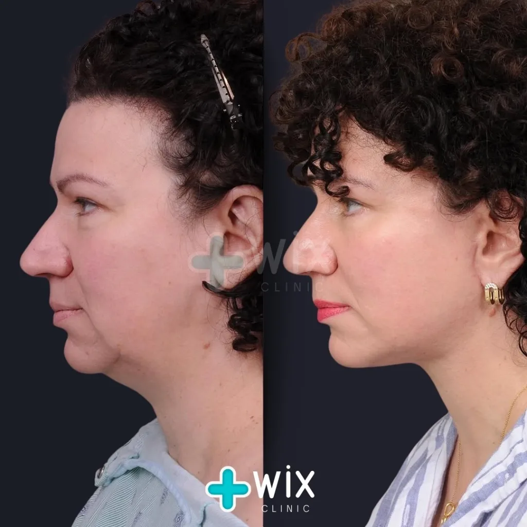 Neck Liposuction Before and After