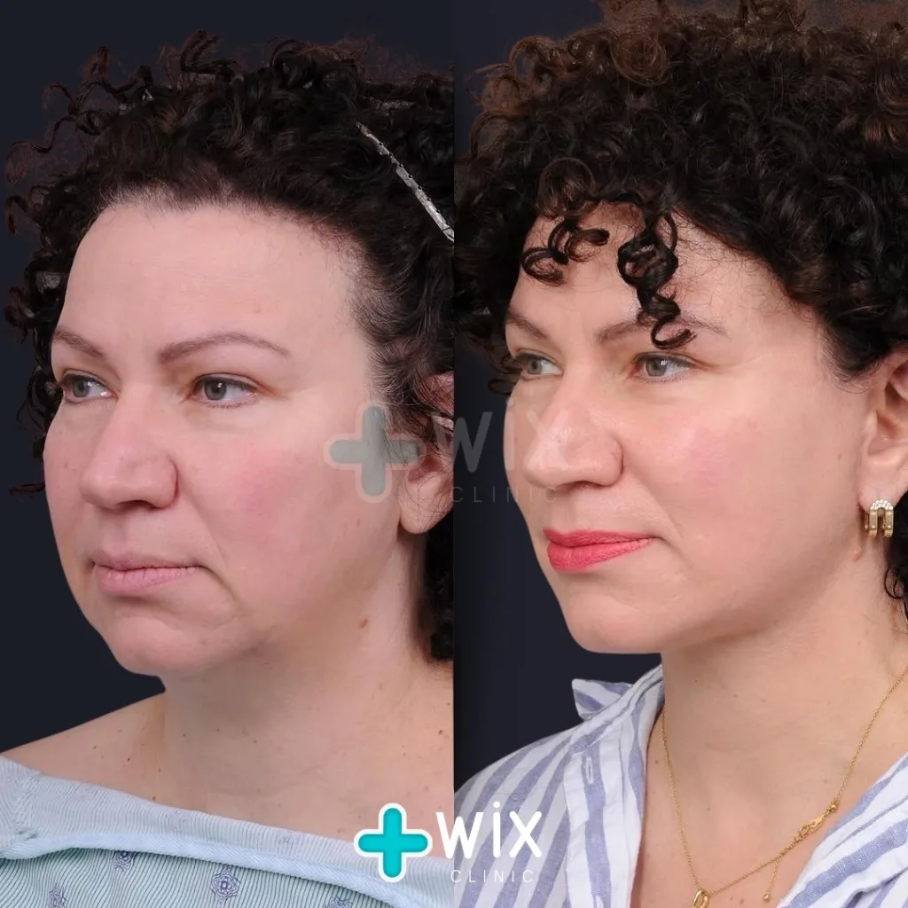 Neck Liposuction Before and After