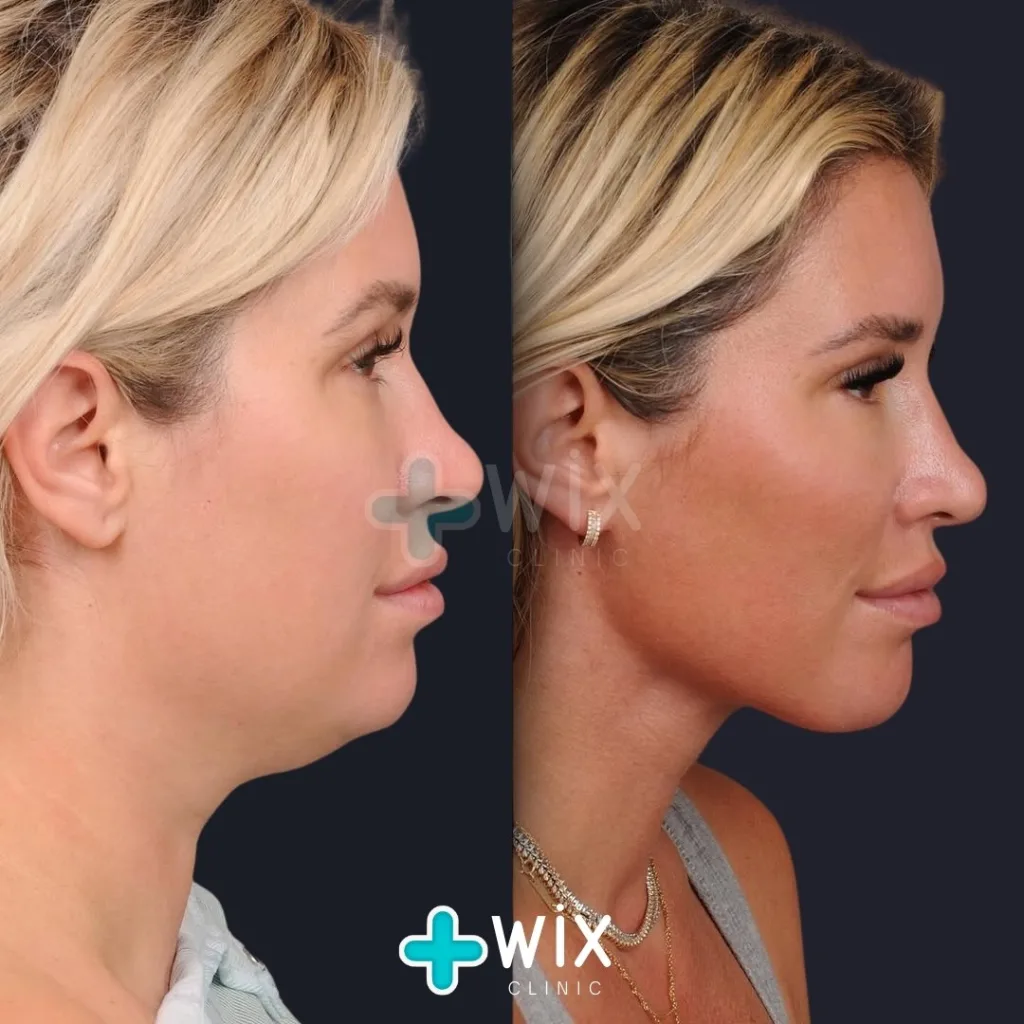 Neck Liposuction Before and After