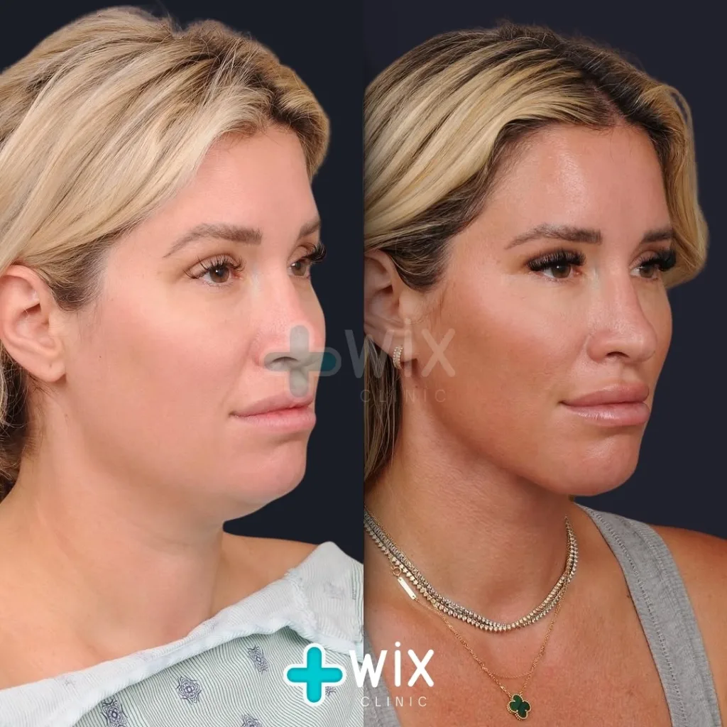 Neck Liposuction Before and After