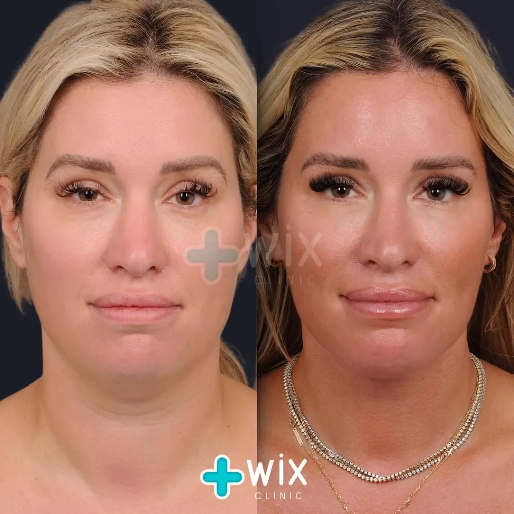 Neck Liposuction Before and After