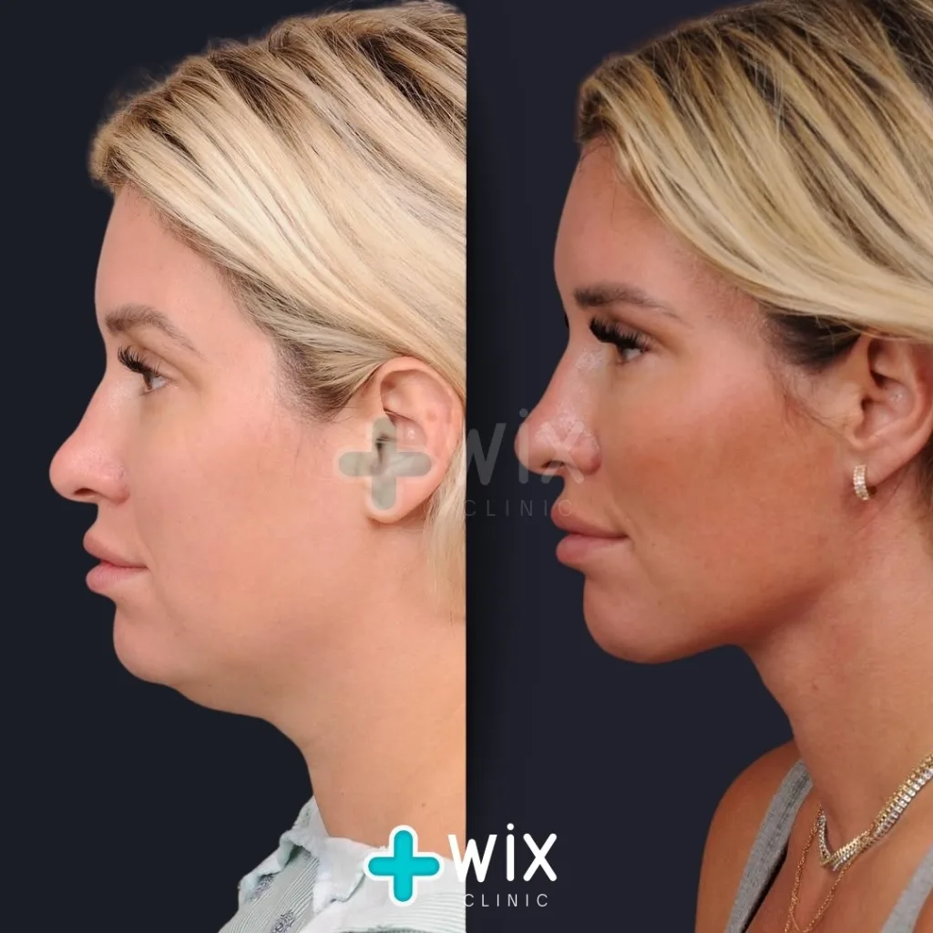 Neck Liposuction Before and After