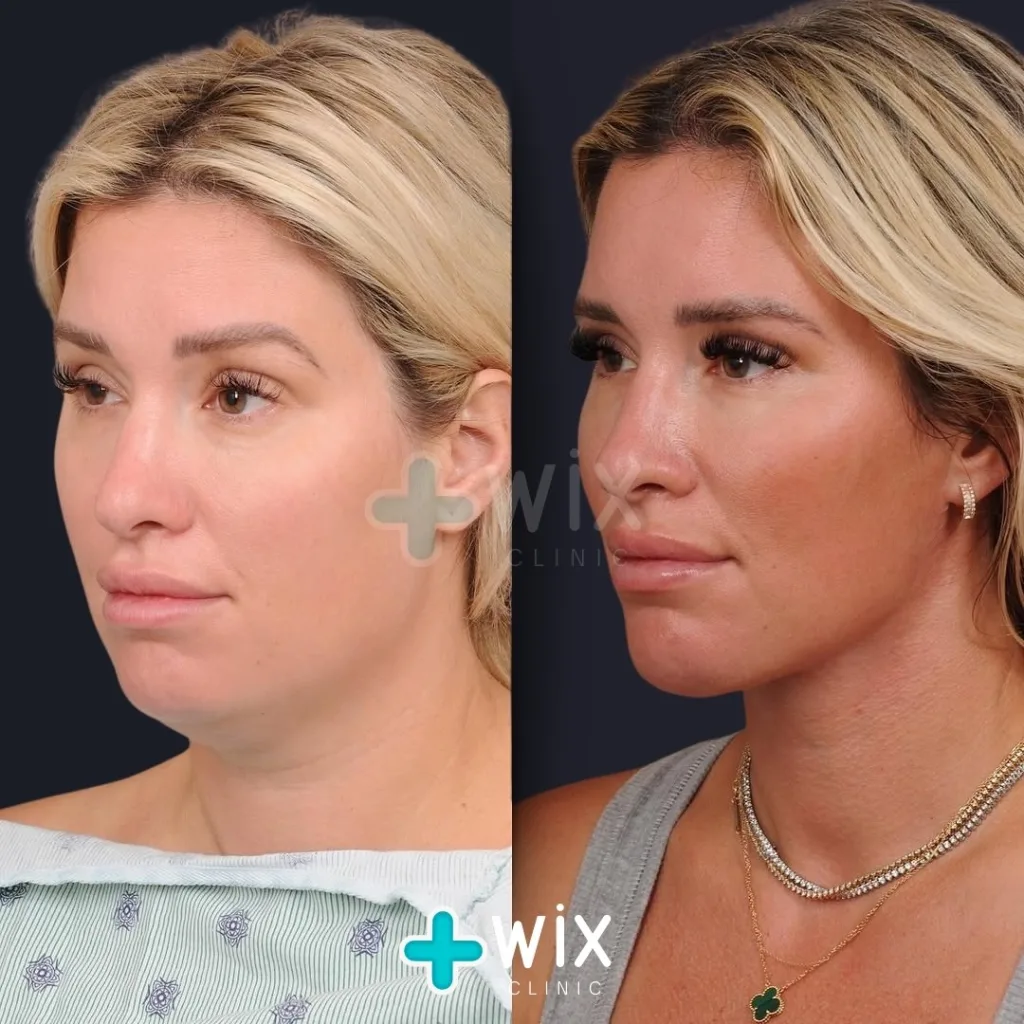 Neck Liposuction Before and After