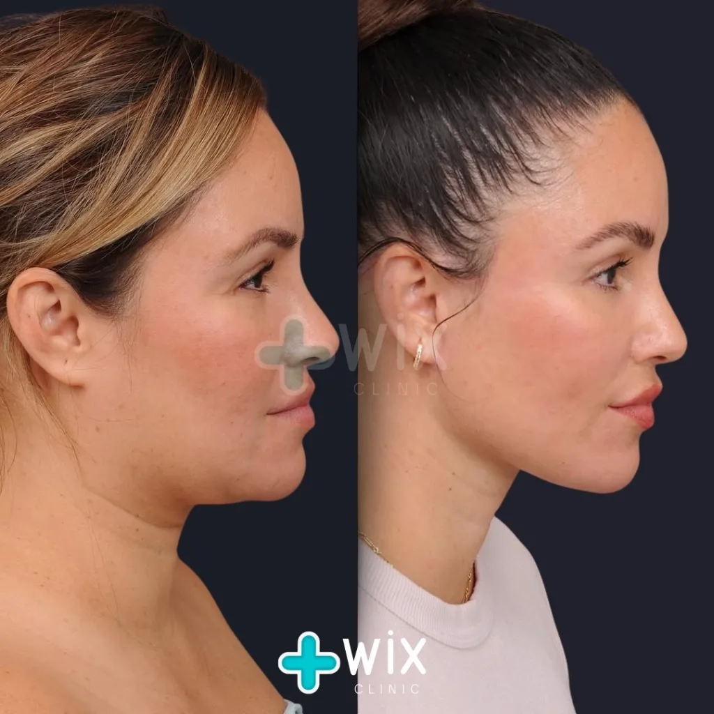 Neck Liposuction Before and After