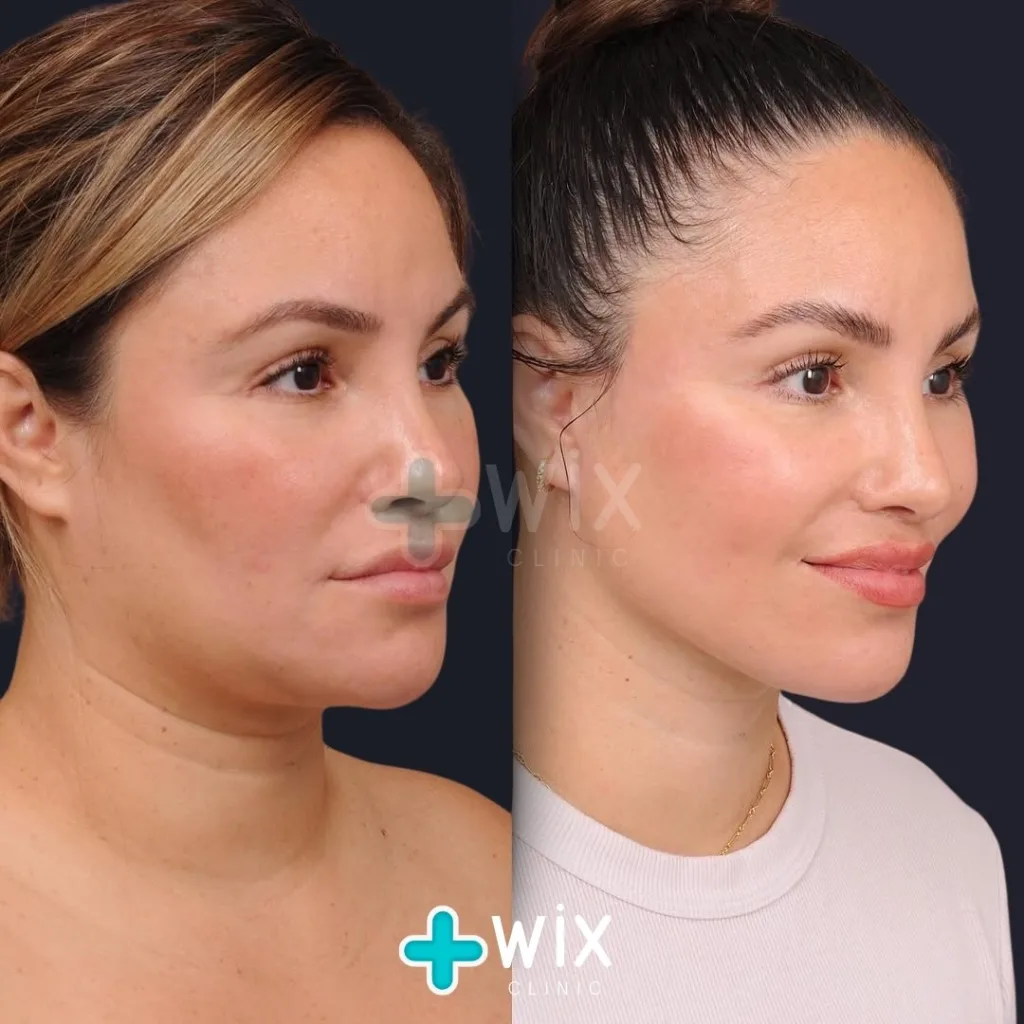 Neck Liposuction Before and After