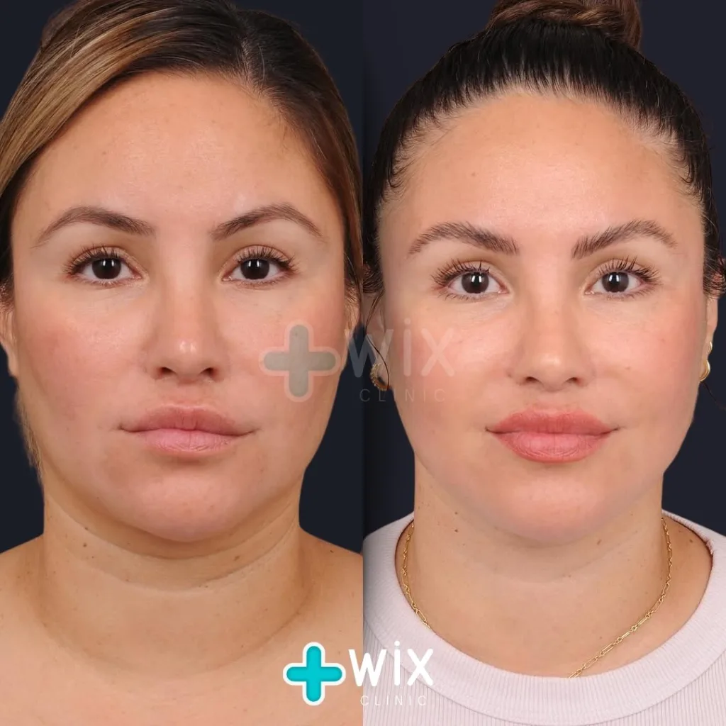 Neck Liposuction Before and After