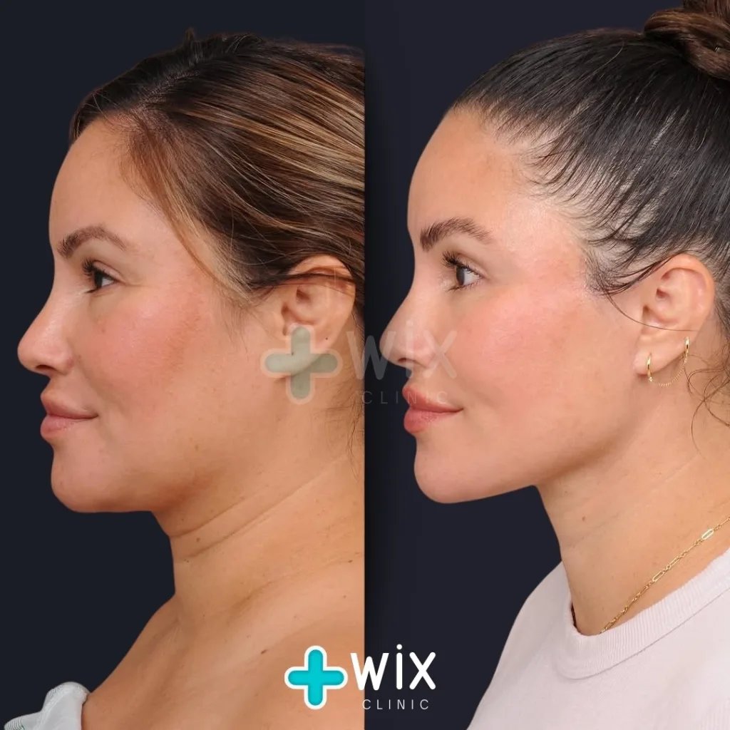 Neck Liposuction Before and After