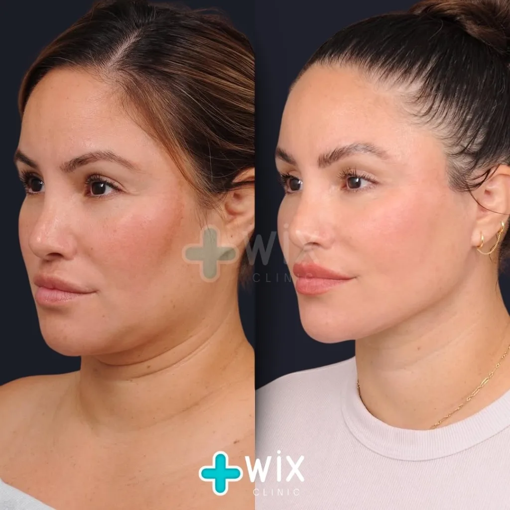 Neck Liposuction Before and After