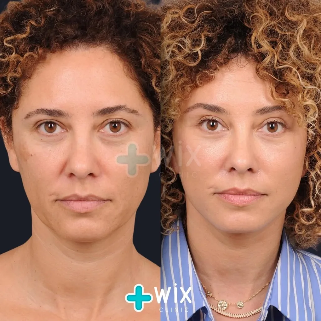 Neck Liposuction Before and After