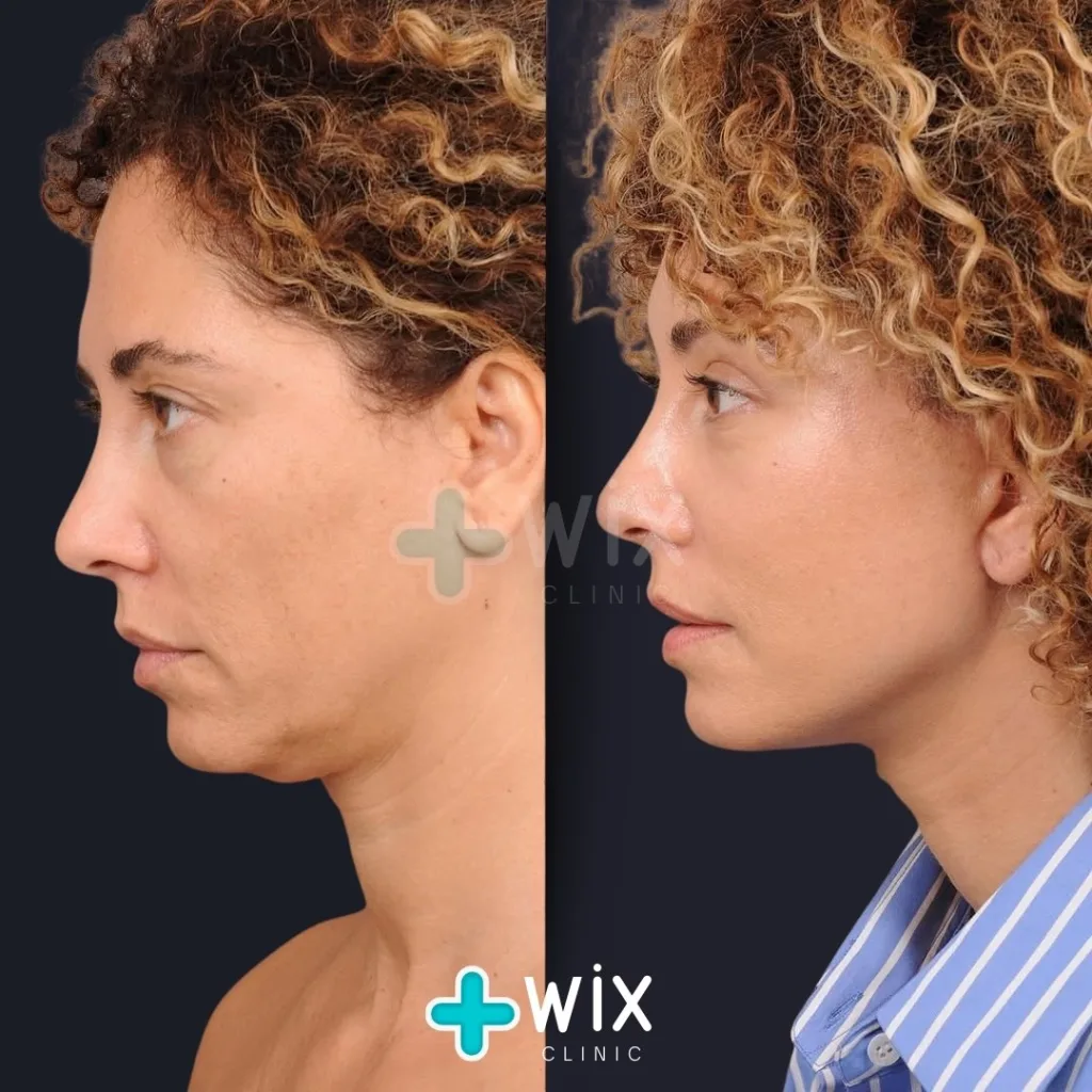 Neck Liposuction Before and After