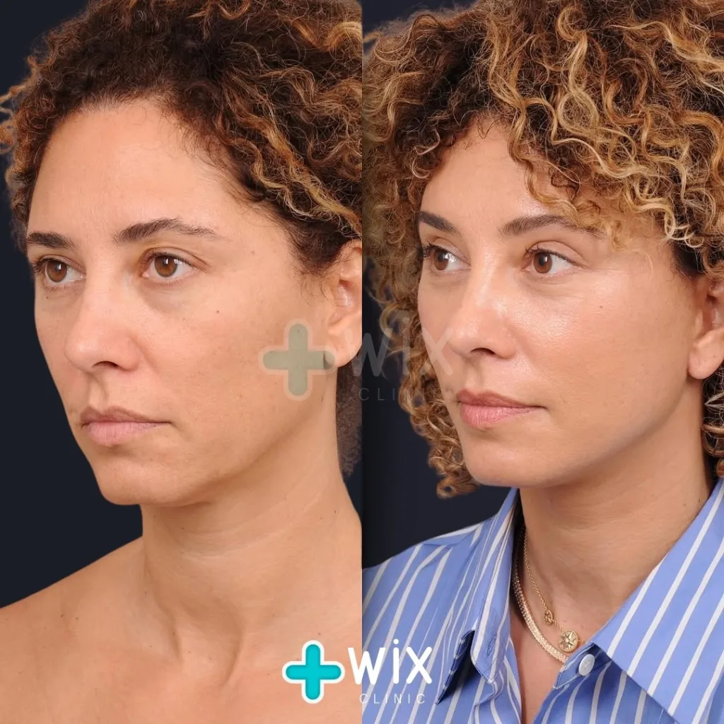 Neck Liposuction Before and After