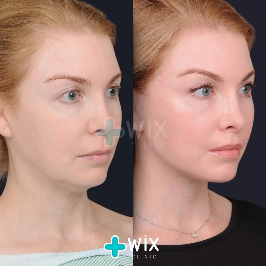 Neck Liposuction Before and After