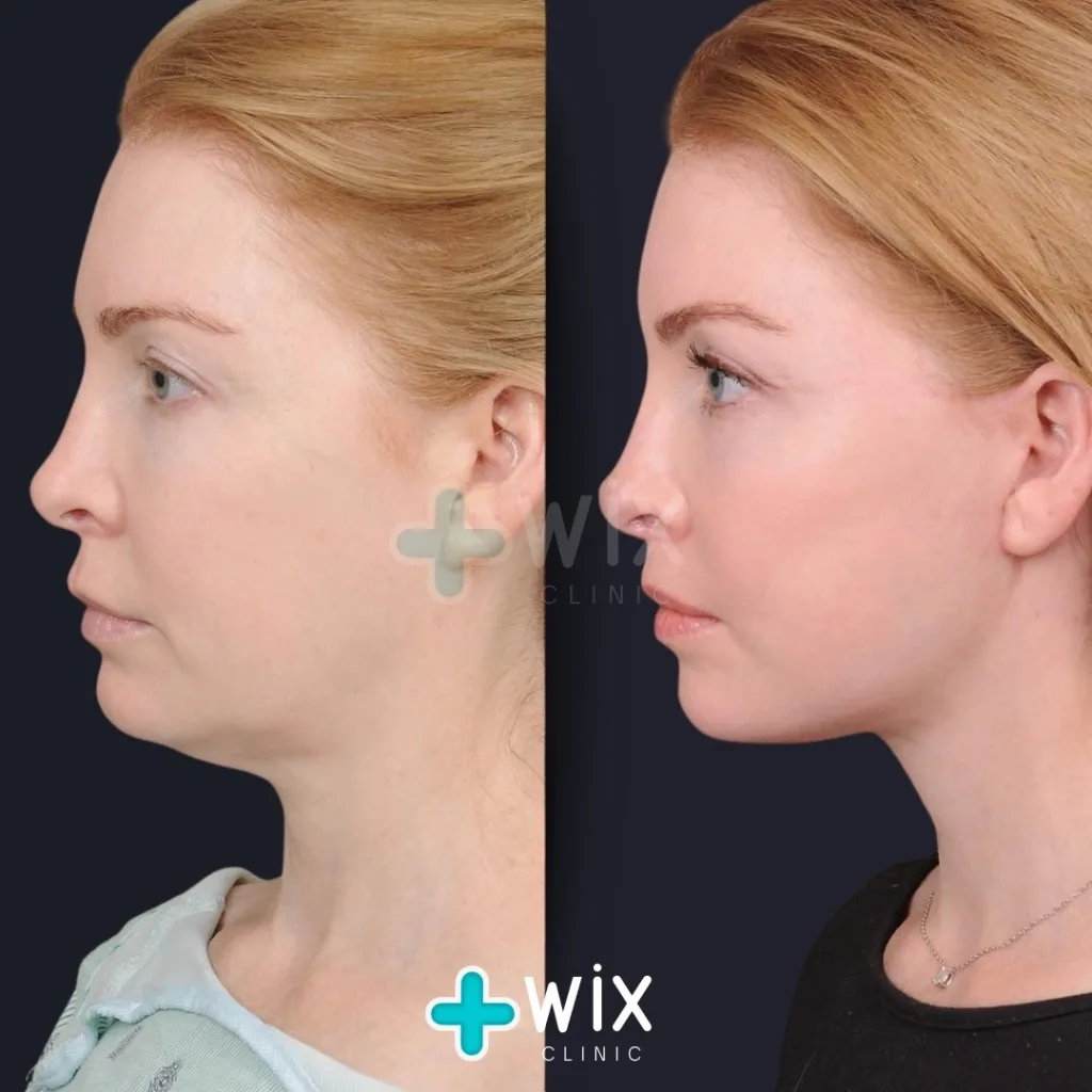 Neck Liposuction Before and After