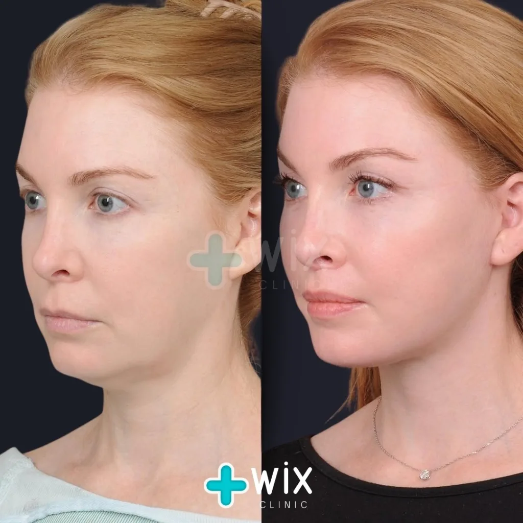 Neck Liposuction Before and After