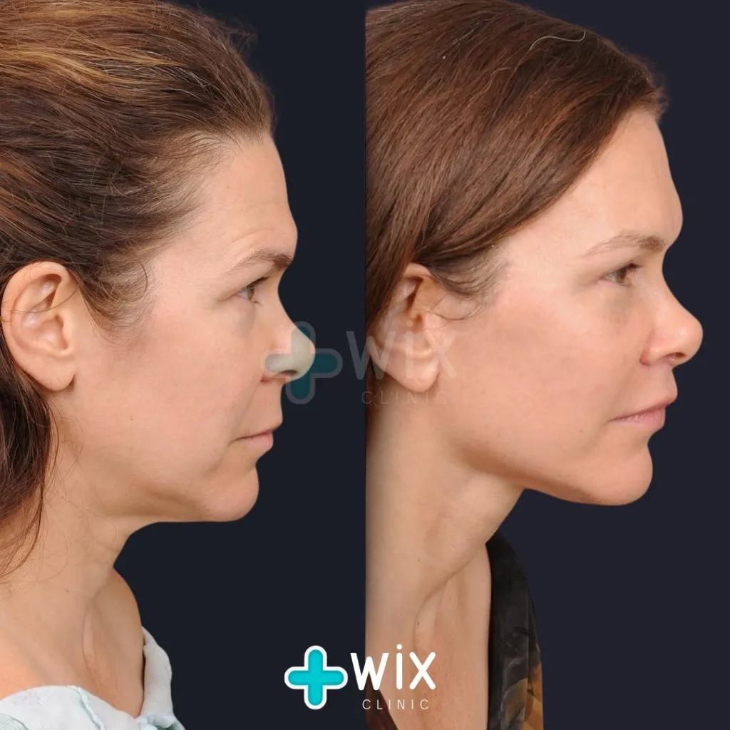 Neck Liposuction Before and After