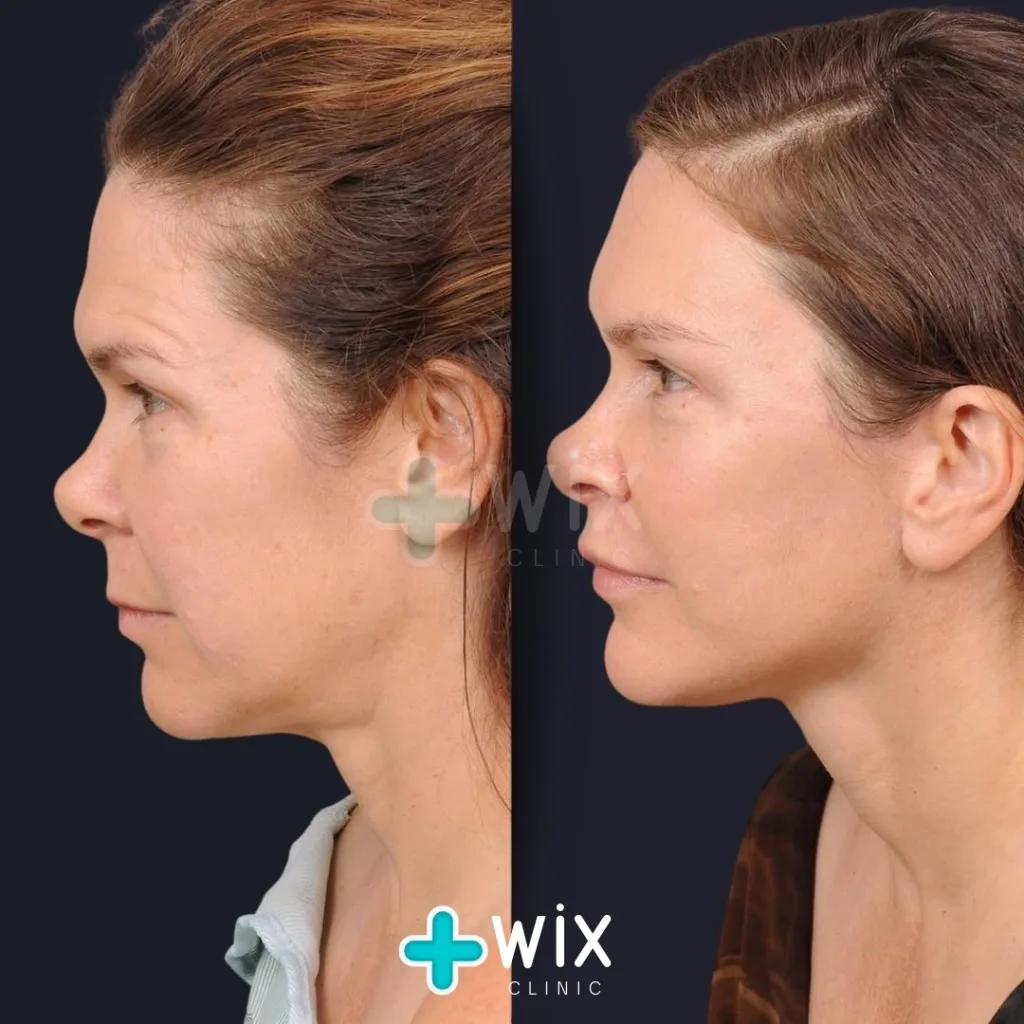 Neck Liposuction Before and After