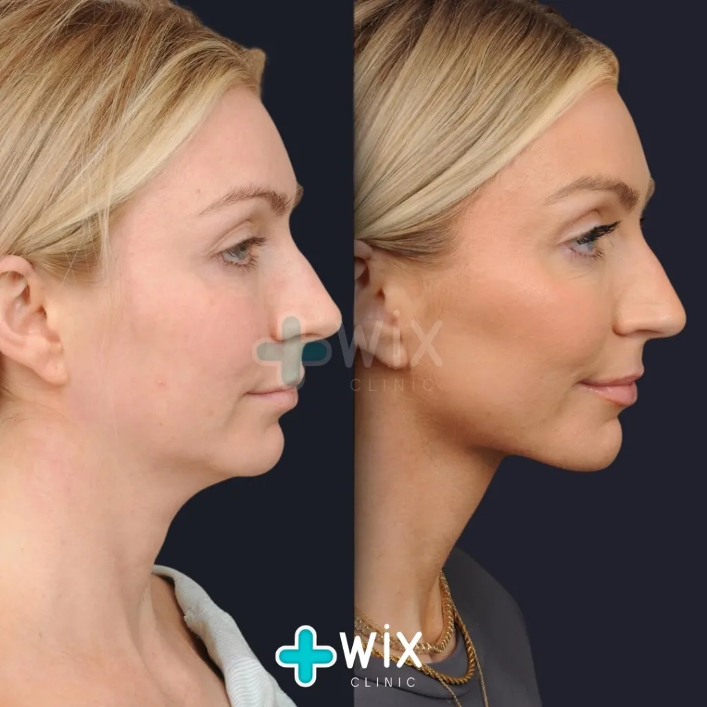 Neck Liposuction Before and After