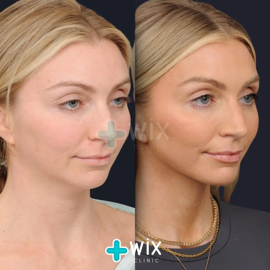 Neck Liposuction Before and After