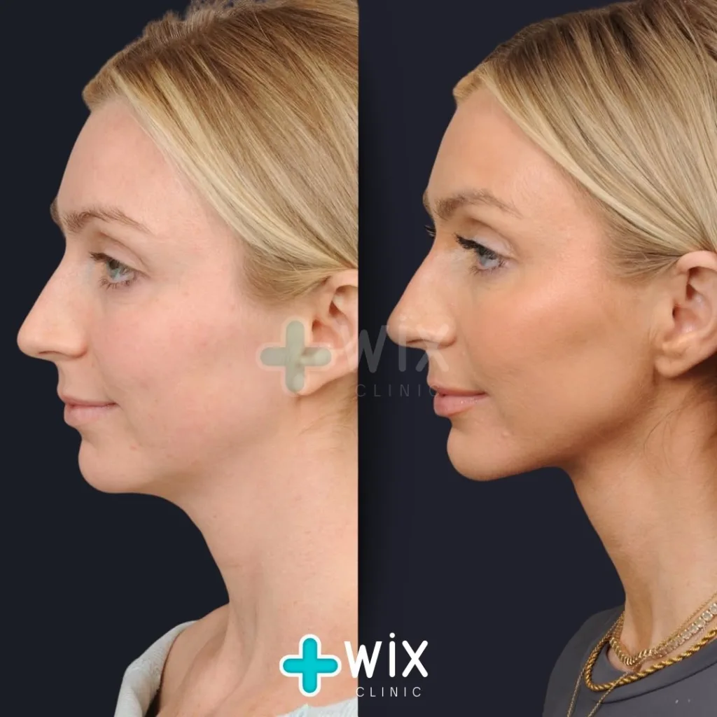 Neck Liposuction Before and After