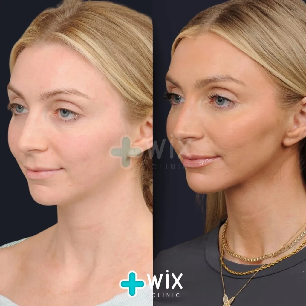 Neck Liposuction Before and After