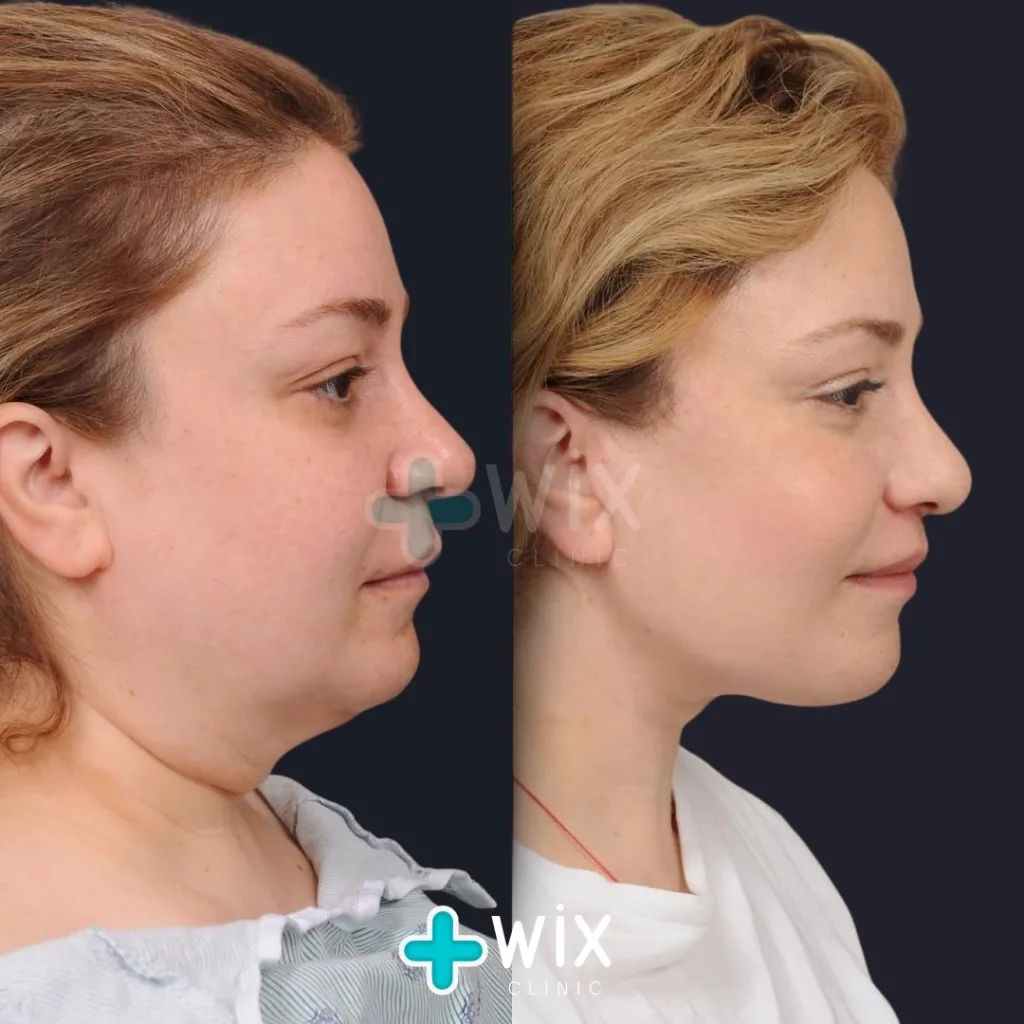 Neck Liposuction Before and After