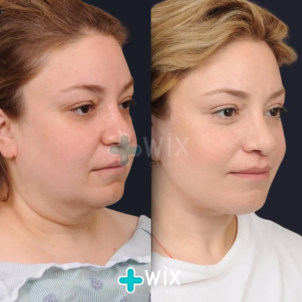 Neck Liposuction Before and After