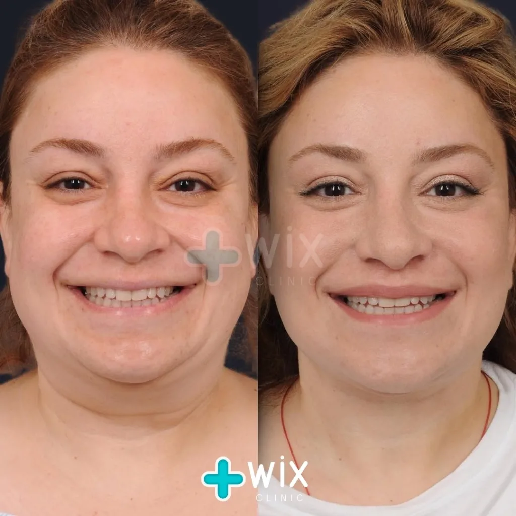 Neck Liposuction Before and After