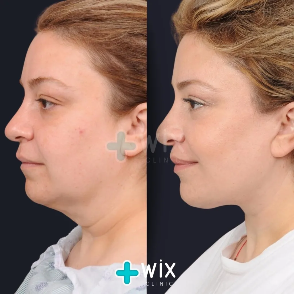 Neck Liposuction Before and After