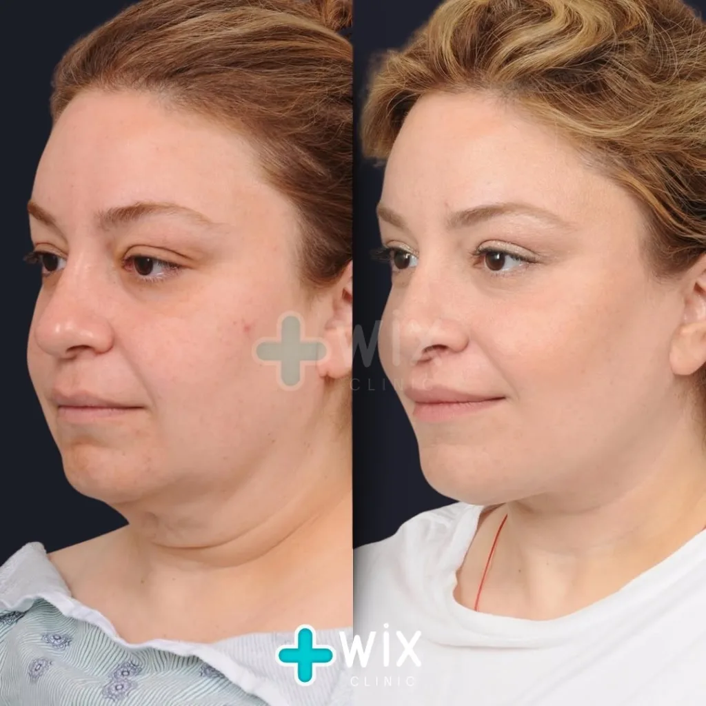 Neck Liposuction Before and After