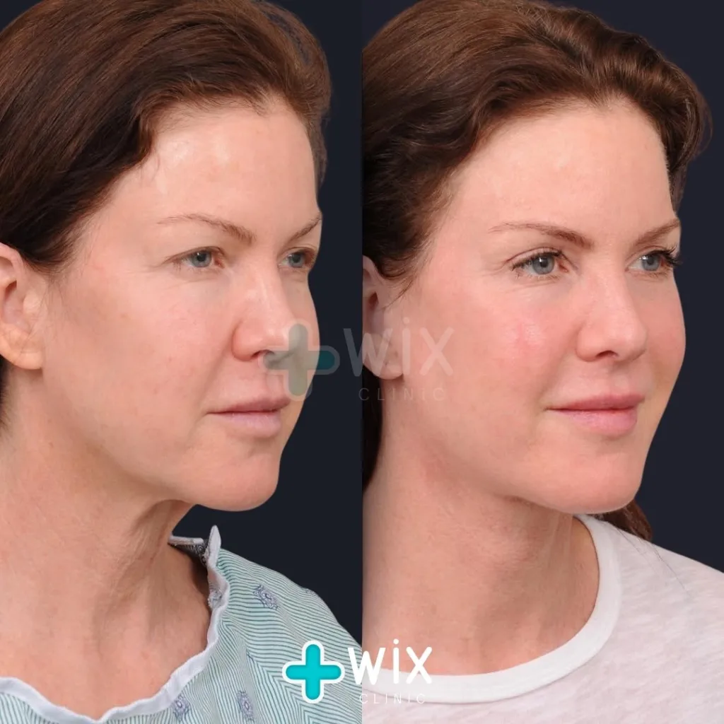 Neck Liposuction Before and After