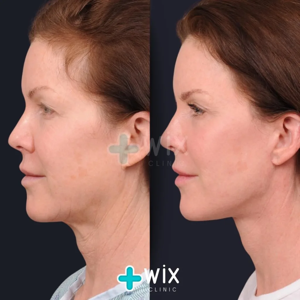 Neck Liposuction Before and After