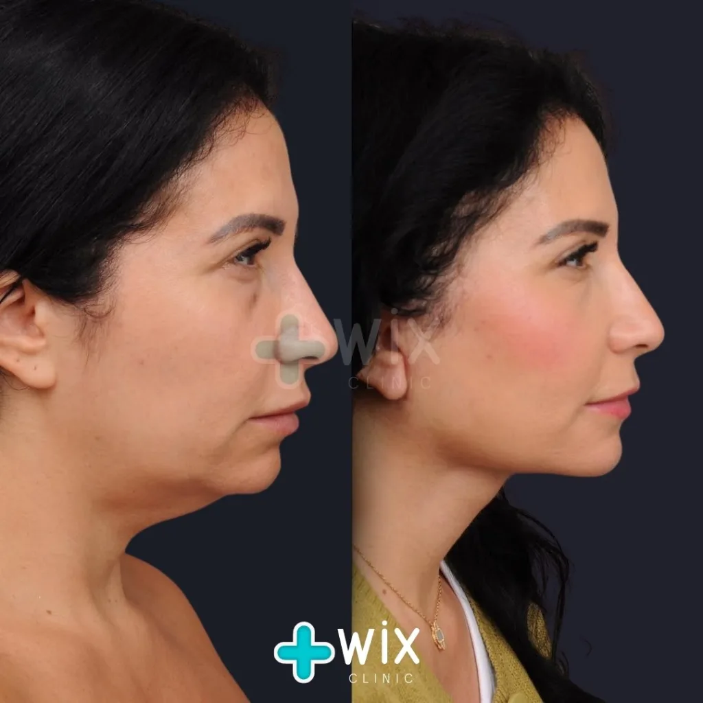 Neck Liposuction Before and After