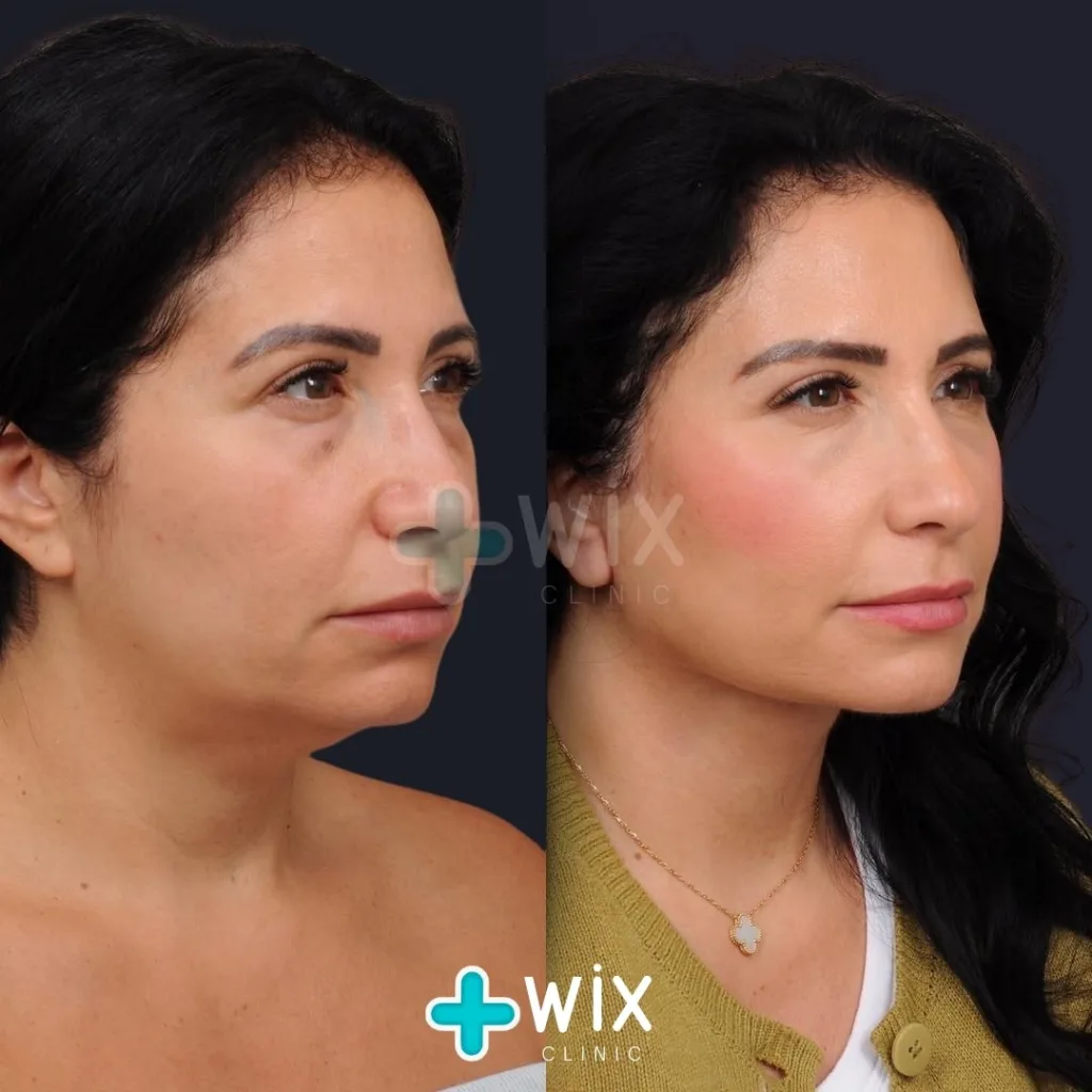 Neck Liposuction Before and After