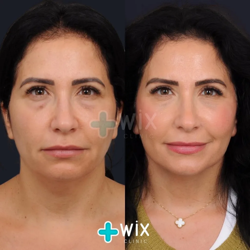 Neck Liposuction Before and After