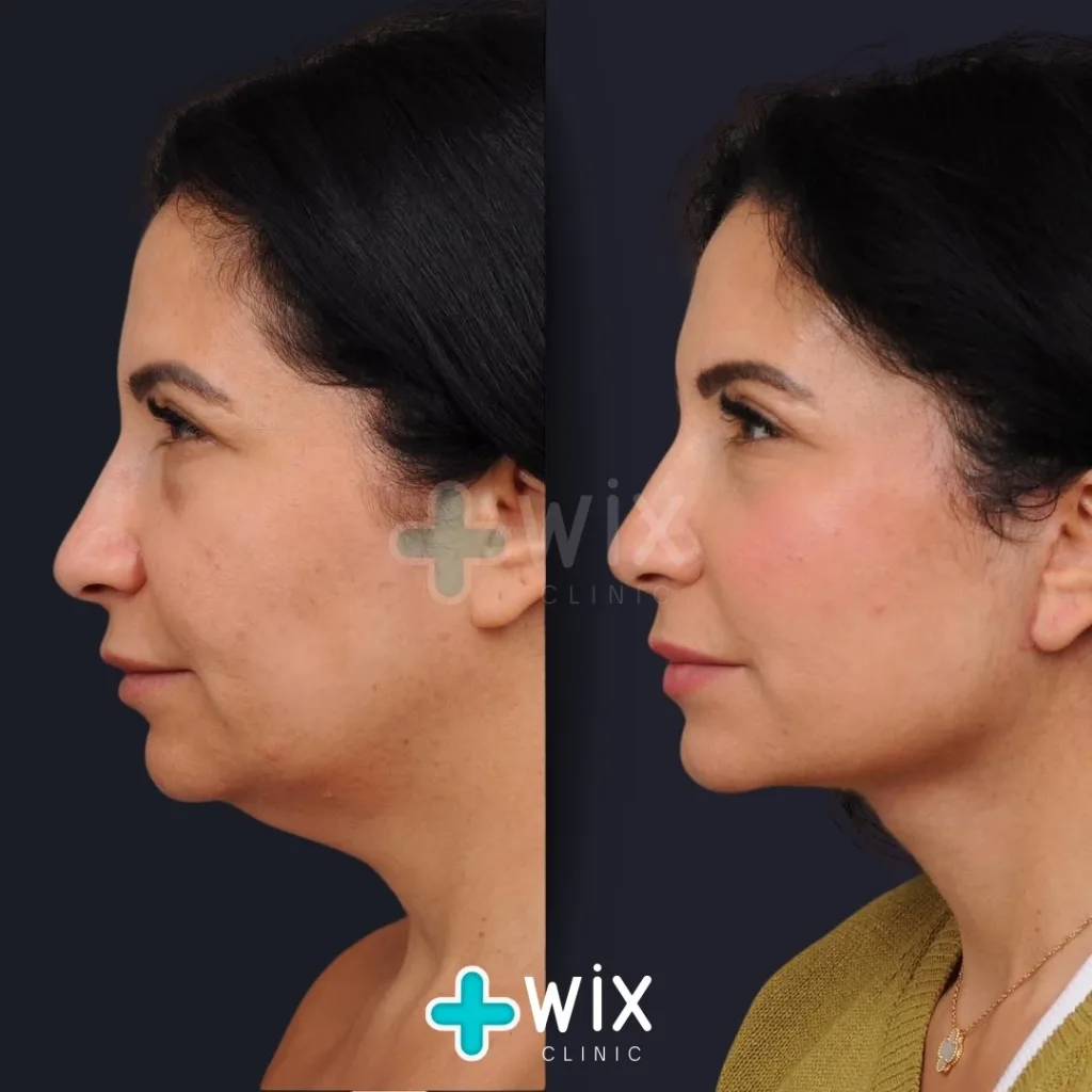 Neck Liposuction Before and After