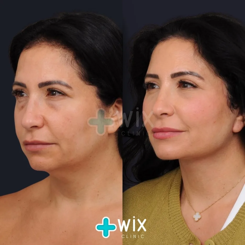 Neck Liposuction Before and After